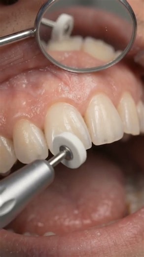 Satisfying Teeth Stain Removal & Polishing | Dental Deep Cleaning #toothcleans #satisfyingdental