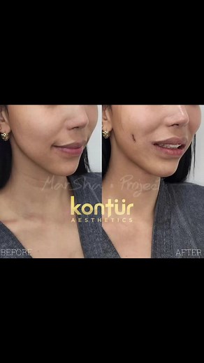 SURGICAL DIMPLEPLASTY A.k.a. Dimple Creation 😊 Dimpleplasty is a type of cosmetic surgery used to create dimples on the cheeks. 😊 Dimples are the indentations that occur when some people smile. 😊 They’re most often located on the bottoms of the cheeks. 😊 Not everyone is born with this facial trait. 😊 In some people, dimples are naturally occurring from indentations in the dermis caused by the deeper facial muscles. 😊 Others may be caused by injury. 😊 Regardless of their causes, dimples ar