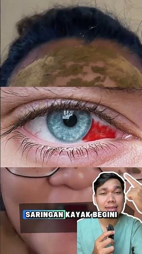 WHY ARE MY EYES BLOODSHOT? / Subconjunctival Hemorrhage