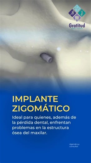 Clinica Dental y Estetica Gratitud on Instagram: "🌟 Implante cigomático: Ideal para quienes, además de la pérdida de dientes, enfrentan problemas en la estructura ósea del maxilar. Vea en qué casos está indicada esta técnica: 🔹 Mandíbula atrófica: La pérdida de dientes debilita la mandíbula debido a la falta de masticación, lo que lleva a la atrofia ósea. 🔹 Pérdida ósea severa: causada por problemas de salud, incluidas enfermedades genéticas no tratadas, que resultan en consecuencias irrevers