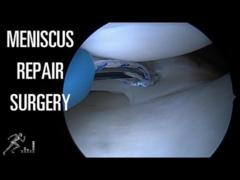 Meniscus tear: Meniscal repair, or sewing the tear back together