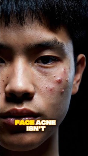 The REAL Reason You Get Acne 😱 (Nobody Tells You This!)