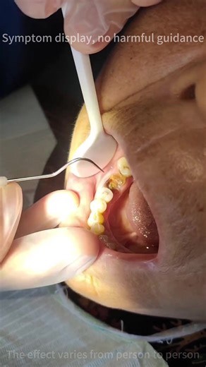 Understanding Tooth Decay and Its Impact on Oral Health