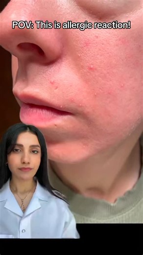 Dr. Farzan | Pustules may form when your skin becomes inflamed as a result of an allergic reaction to food, environmental allergens, or poisonous insect... | Instagram