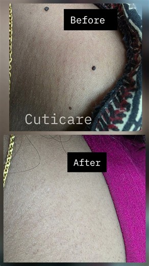 Skin tags bothering you? Simple, safe removal by a dermatologist. #SkinTagRemoval