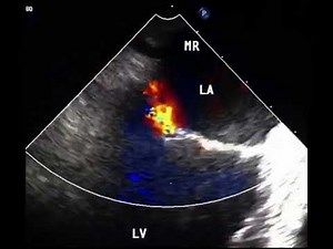 Mitral Regurgitation: Why TEE is Superior to TTE in Assessment