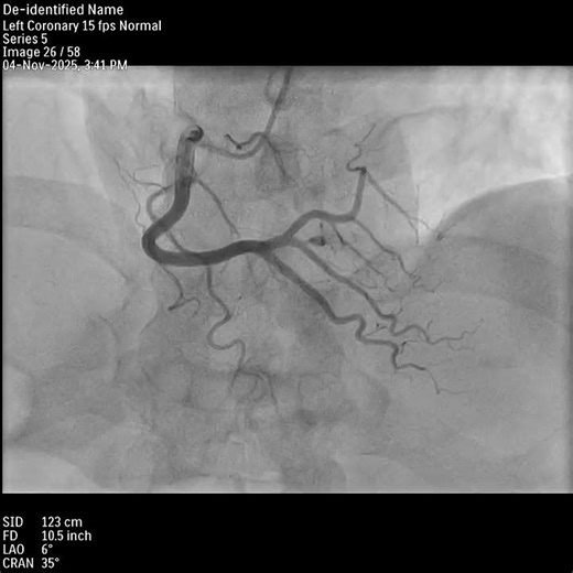 RCA Angiogram showing PDA & PLVB | Right Dominant Coronary Circulation