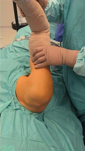 Shoulder Examination under anesthesia #shoulderpain #shoulderinjury #shoulder