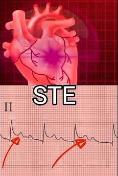 Myocardial Infarction Explained: Symptoms, ECG Signs & Emergency Management for Doctors