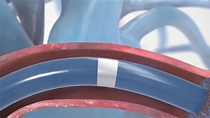 Martin Bocks MD Discusses use of Piccolo Occluder Device to Repair Patent Ductus Arteriosus