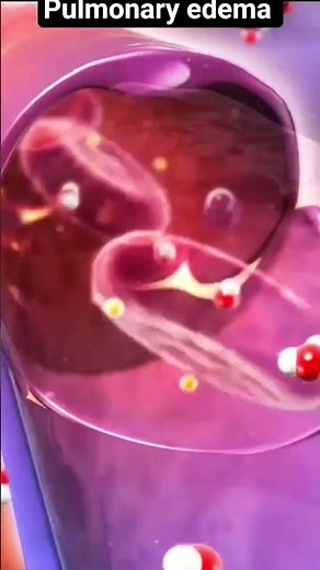 Pulmonary edema