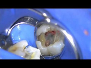 Extirpation of pulp