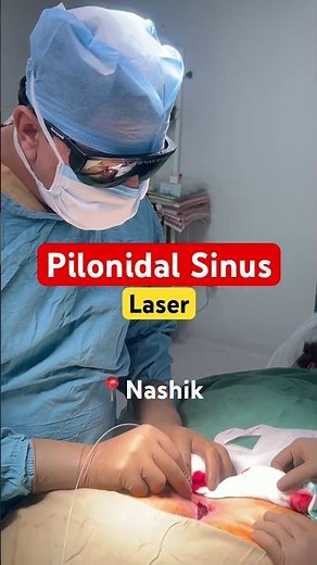Infected Cyst Near Tailbone? Watch This Laser Treatment Work! #shortsfeed #pilonidal #shorts #piles
