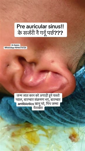 Preauricular Sinus Excision Explained