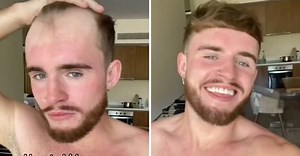 TikTokker shares tricks on how to hide a receding hairline