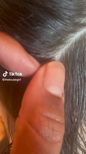 The Louse Girl Lice Removal on TikTok
