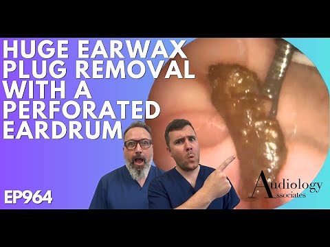 HUGE EAR WAX PLUG REMOVAL WITH A PERFORATED EARDRUM - EP964