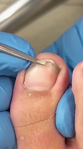 Effective Ways to Remove an Ingrown Toenail: A Step-by-Step Guide