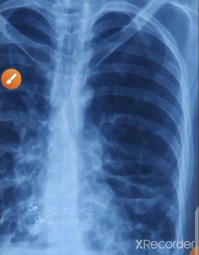 3 signs of bronchiectasis on chest xray and treatment | asthma and its complications#chestxray#mbbs