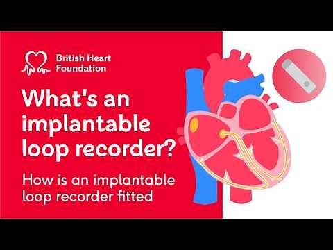 What is an implantable loop recorder?