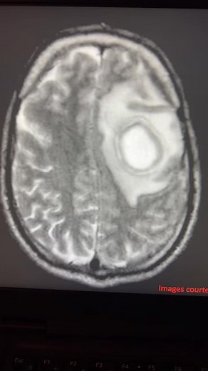 Brain abscess on MRI #MRI #Brain #Anatomy #learning #fyp #fy #learningiscool #neuro #neurotiktok #pathology