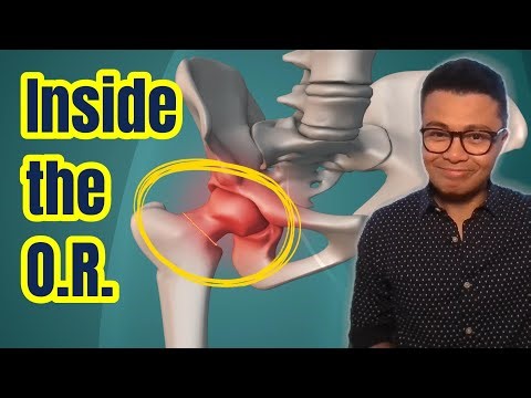 Inside Hip Fracture Repair Surgery: The Complete Procedure!