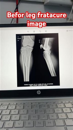 Leg fracture # x ray image# before After image