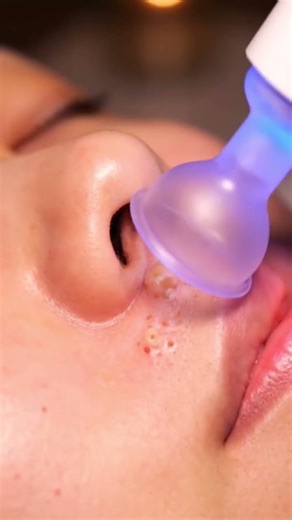 Relaxing Skincare ASMR: Deep Skin Cleansing with Blue-Light Vacuum (No Talking) #shortsfeed