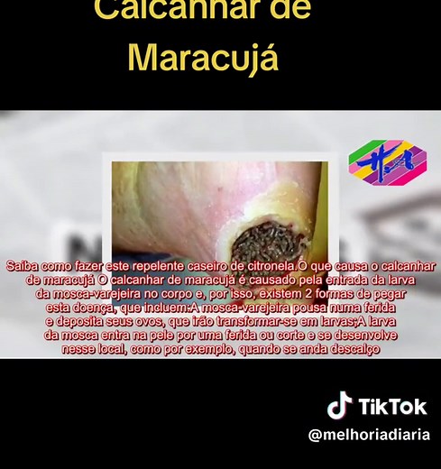 Calcanhar de Maracujá: Tudo que Você Precisa Saber