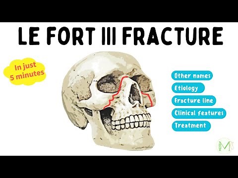Le Fort III Fracture | Made easy in 5 Minutes | Medinare