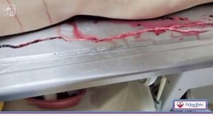 Dr. Jane Ruby Live - Mr. Richard Hirschman, Embalmer, Find Veins & Arteries Filled with Never Before Seen Rubbery Clots