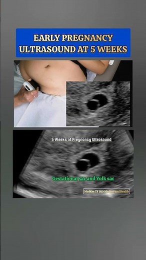 Early Pregnancy at 5 Weeks : Ultrasound Findings