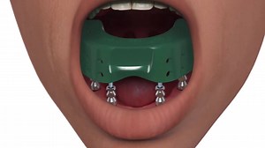 Use this technique to make an impression of Multi-unit abutments utilizing an open tray, direct pick-up method for fabrication of a working model at the dental laboratory. This procedure creates a model that represents the exact position of the Multi-unit abutments and the soft tissue profile. | BioHorizons
