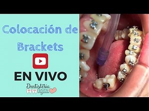 LIVE BRACKET PLACEMENT - Upper and lower crowding