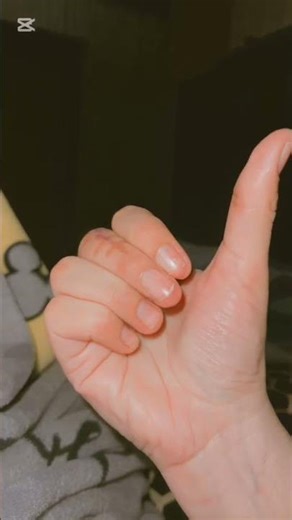 Recovery after phalangeal joint dislocation middle finger. #physiotherapy #medical #hospital