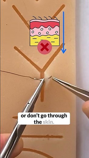 How to do the Deep Dermal Suture!