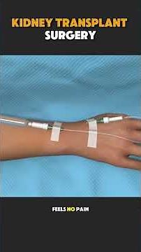 Kidney Transplant Surgery Explained | Procedure Explained #KidneyTransplant #KidneyTransplantSurgery