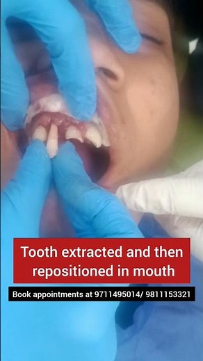 Tooth knocked out of place put back in position; Tooth Avulsion; Dr. Srishti Bhatia