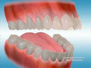 Braces and Distalizing appliances