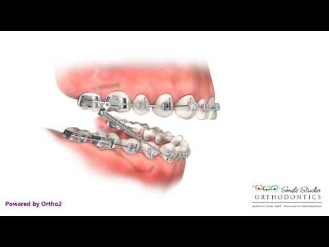Forsus - Orthodontic Appliance