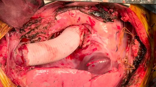 Bentall procedure with a continuous suture technique