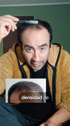 ¿La calvicie viene de familia? 🧬 Testimonio de Cristian con boe