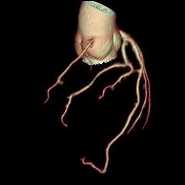 UCSF Radiology: A Rotational View of the Cardiac CT Angiography