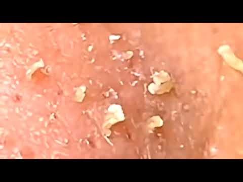 Blackheads. blackheads removal. Blackheads on cheeks, Pimple 30ZONE video | Blackheads Removal