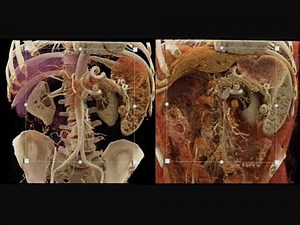 MDCT Evaluation of the Spleen: Challenges in Diagnosis Part 1