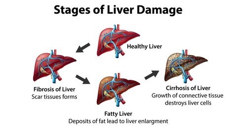 clip-3601692975-visual-progression-liver-damage-stages