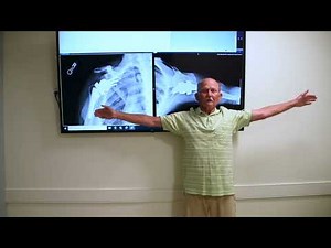 John's Outcome and Experience After Reverse Total Shoulder Arthroplasty (Replacement Surgery)