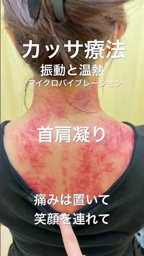 【首肩凝り解消！】カッサ療法