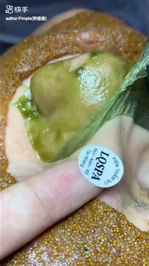 pimples remove mask in side view #youtubeshorts #pimples #shorts #ytshorts