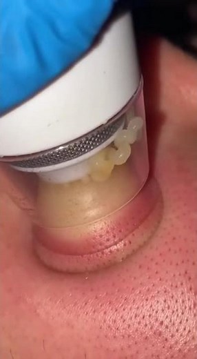 🤯 The MOST Satisfying Pore Vacuum Extraction You'll Ever See! | INSTANT Blackhead Removal!